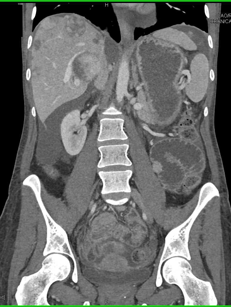 Small Bowel Metastases from Synovial Sarcoma - CTisus CT Scan