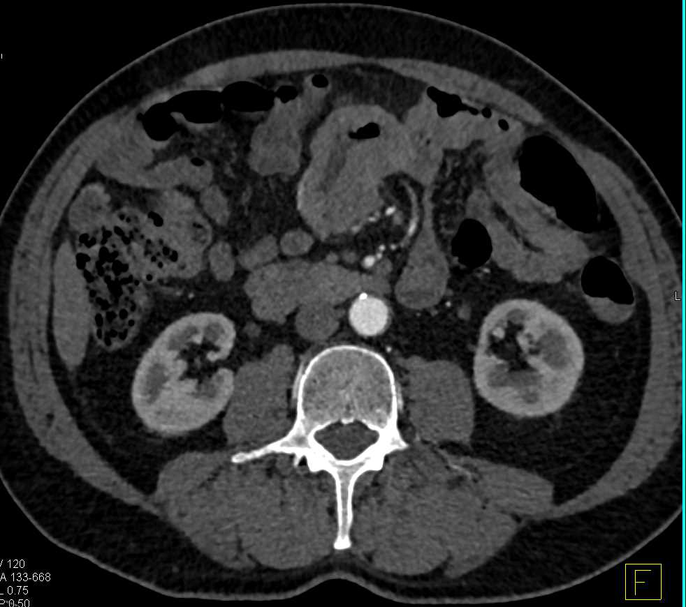 Adenocarcinoma of the Small Bowel - CTisus CT Scan