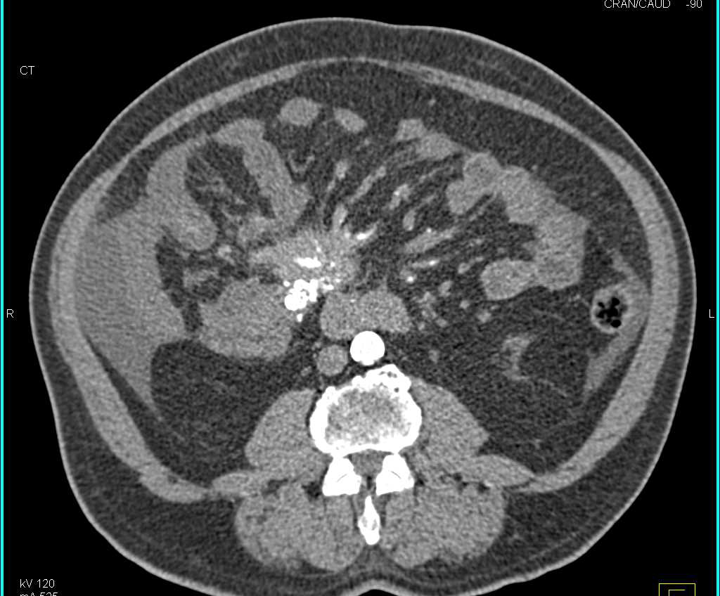 Carcinoid Tumor in the Root of the Mesentery with Desmoplastic Reaction and Carcinomatosis - CTisus CT Scan