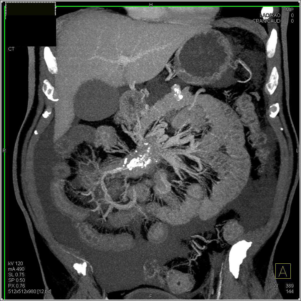 Carcinoid Tumor in the Root of the Mesentery with Desmoplastic Reaction and Carcinomatosis - CTisus CT Scan