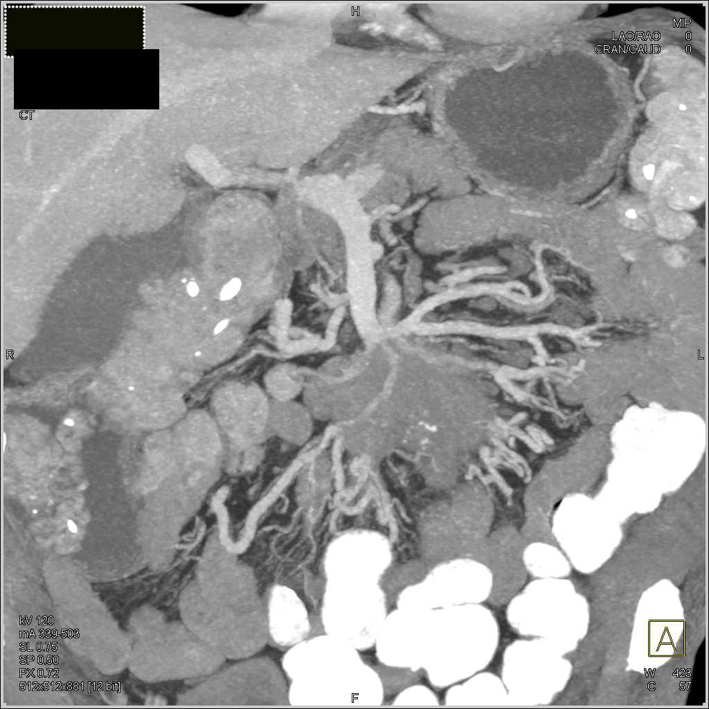 Carcinoid in the Root of the Mesentery Encases the SMA - CTisus CT Scan