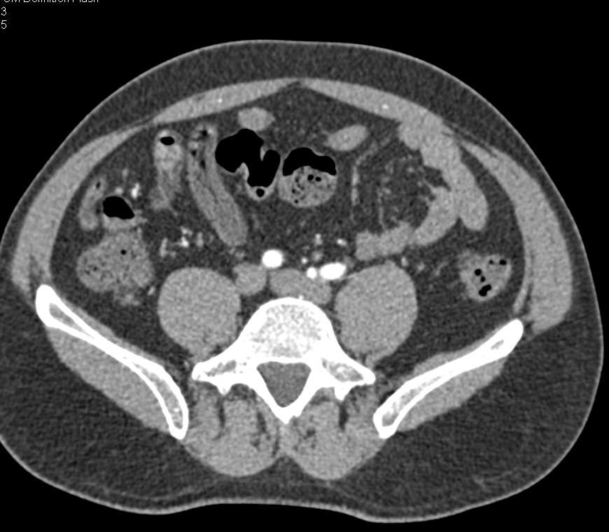 Cystic Nodes in Mesentery in Cavitary Nodal Syndrome - CTisus CT Scan