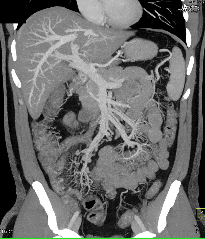 Crohn's Disease Involving Ileum - CTisus CT Scan