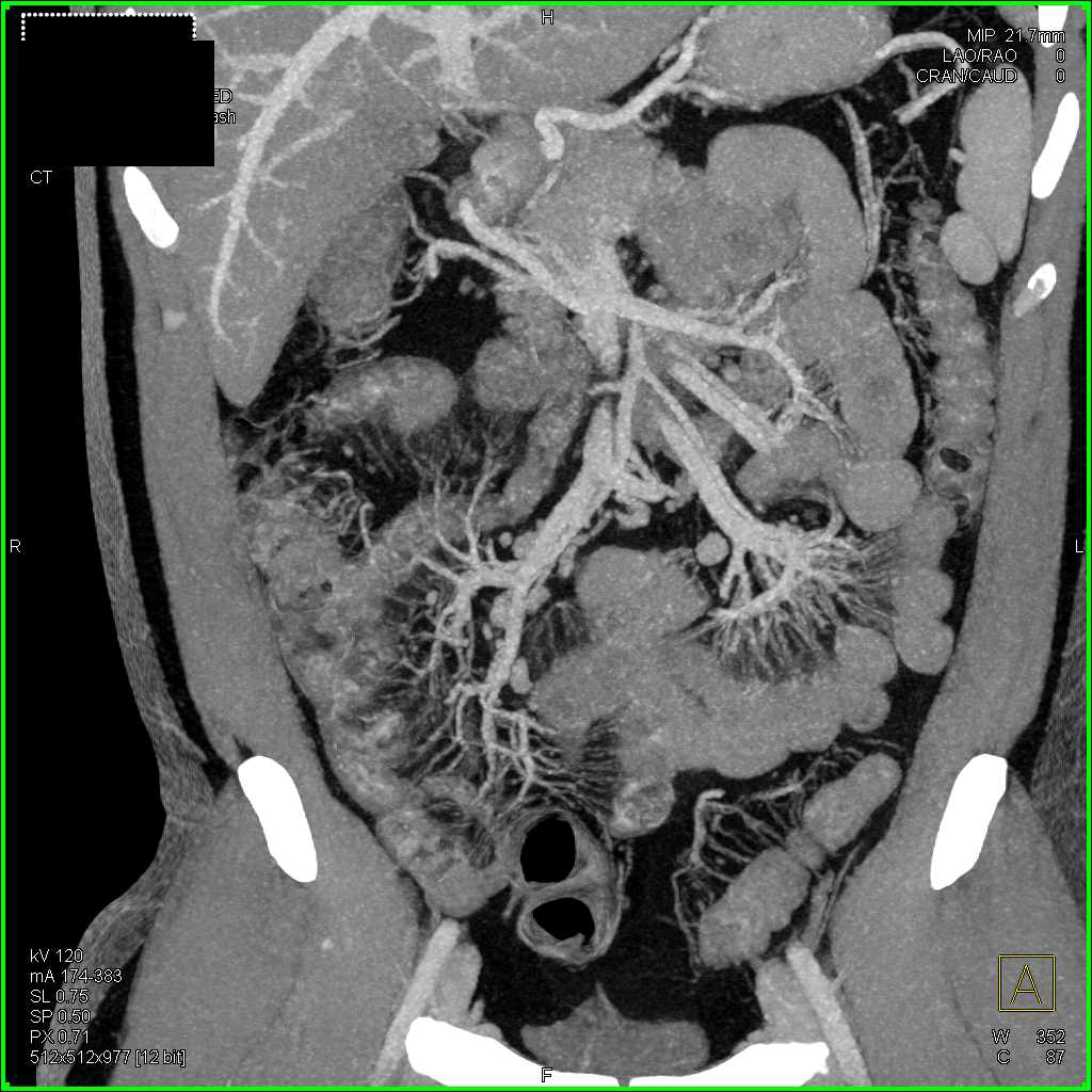 Crohn's Disease Involving Ileum - CTisus CT Scan