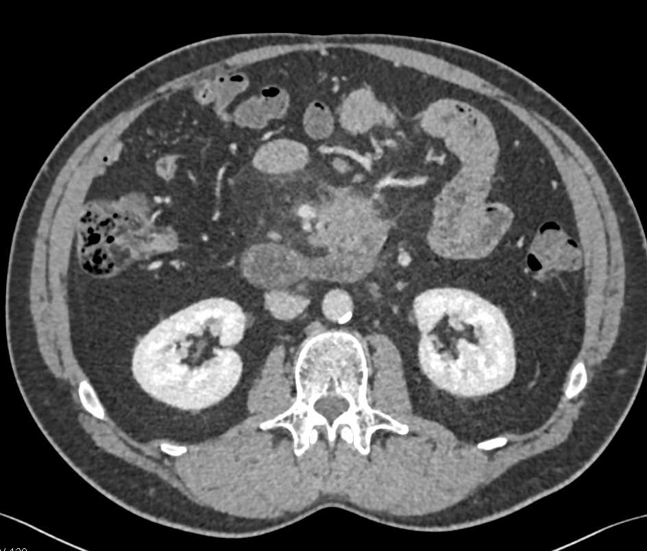 Carcinoid Tumor in the Root of the Mesentery - CTisus CT Scan