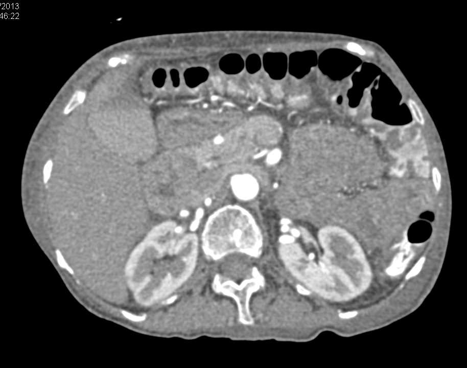 Wet Small Bowel Pattern Without Obstruction - CTisus CT Scan