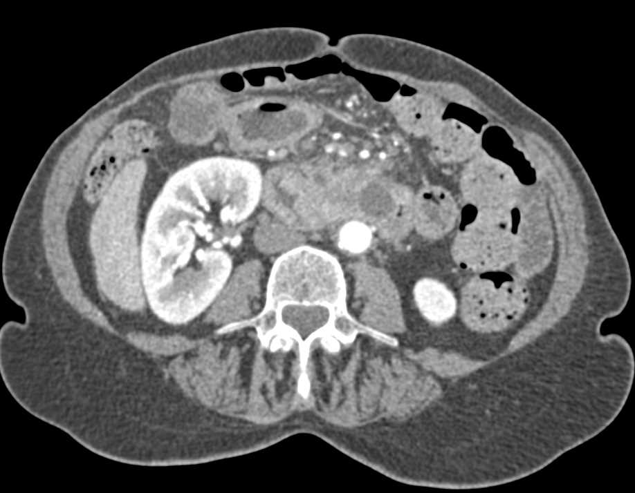 Duodenal Adenocarcinoma - CTisus CT Scan