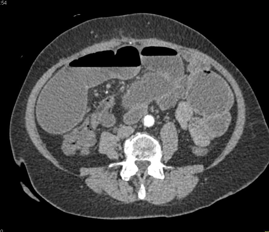 Small Bowel Obstruction due to Crohn's Disease - CTisus CT Scan