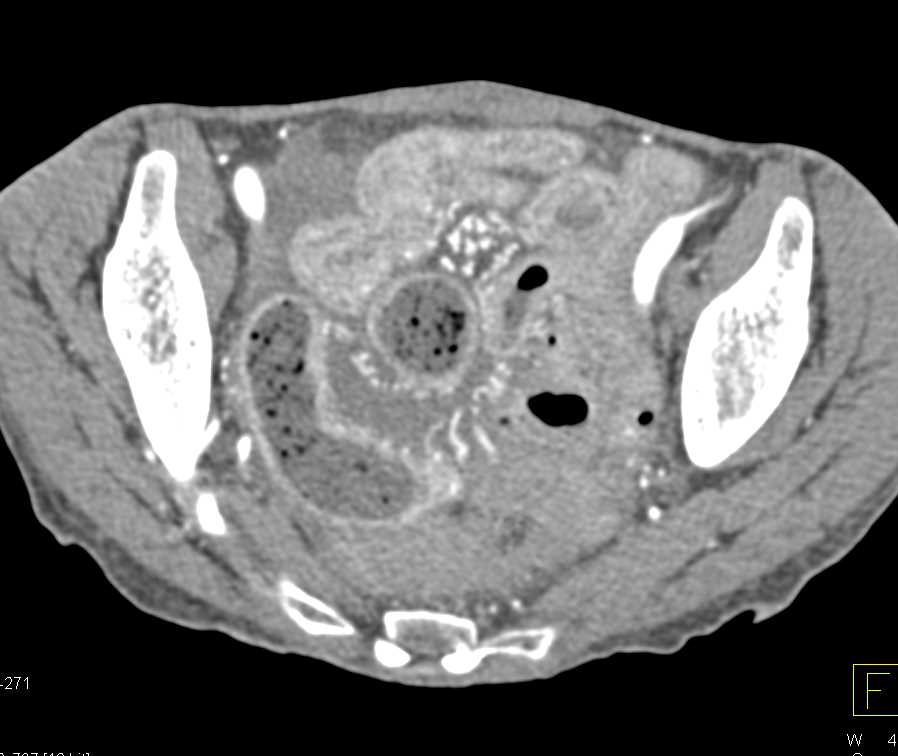 Crohn's Disease with Halo Sign and Feces Sign - CTisus CT Scan