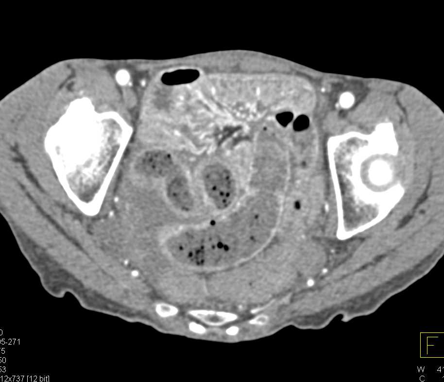 Crohn's Disease with Thickened Small Bowel - CTisus CT Scan