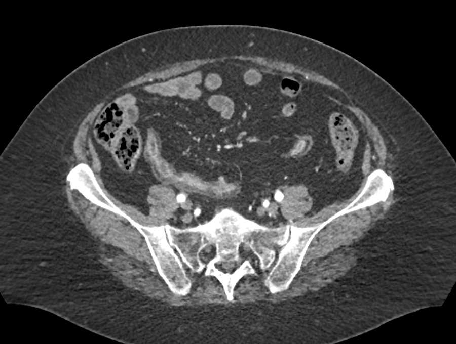 Crohn's Disease with Thickened Small Bowel - CTisus CT Scan