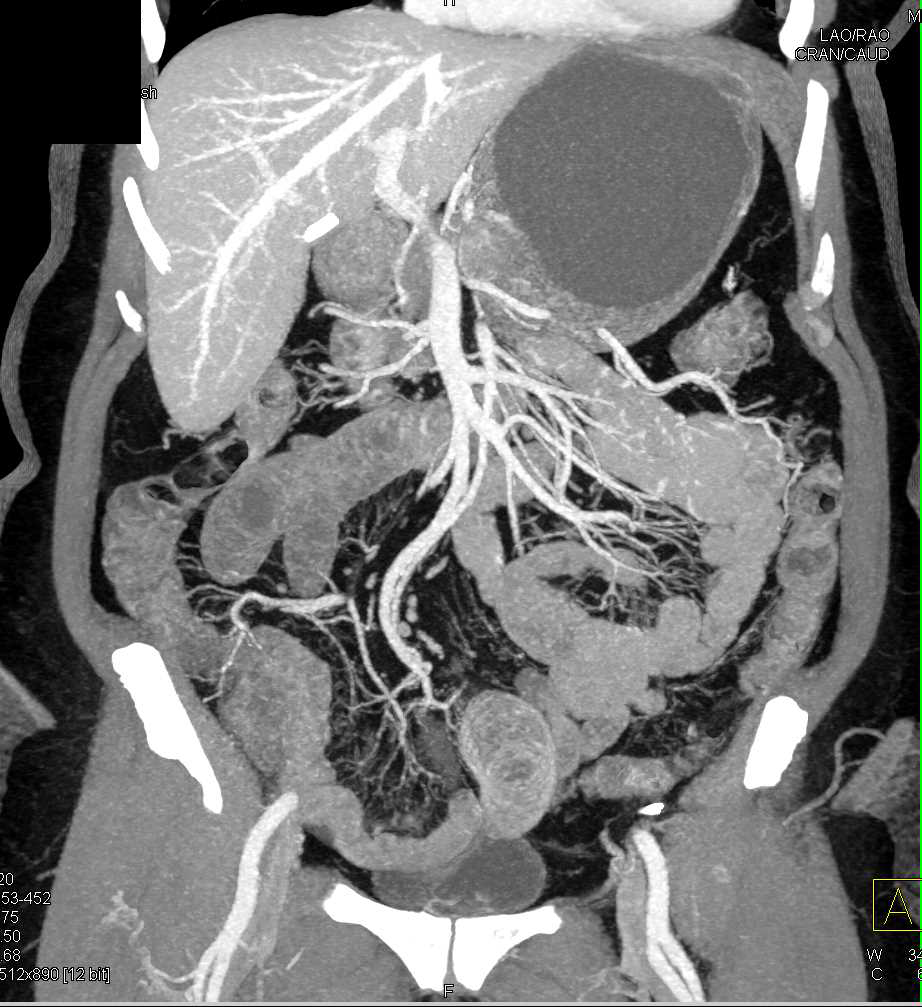 Crohn's Disease with Thickened Small Bowel and Strictures - CTisus CT Scan