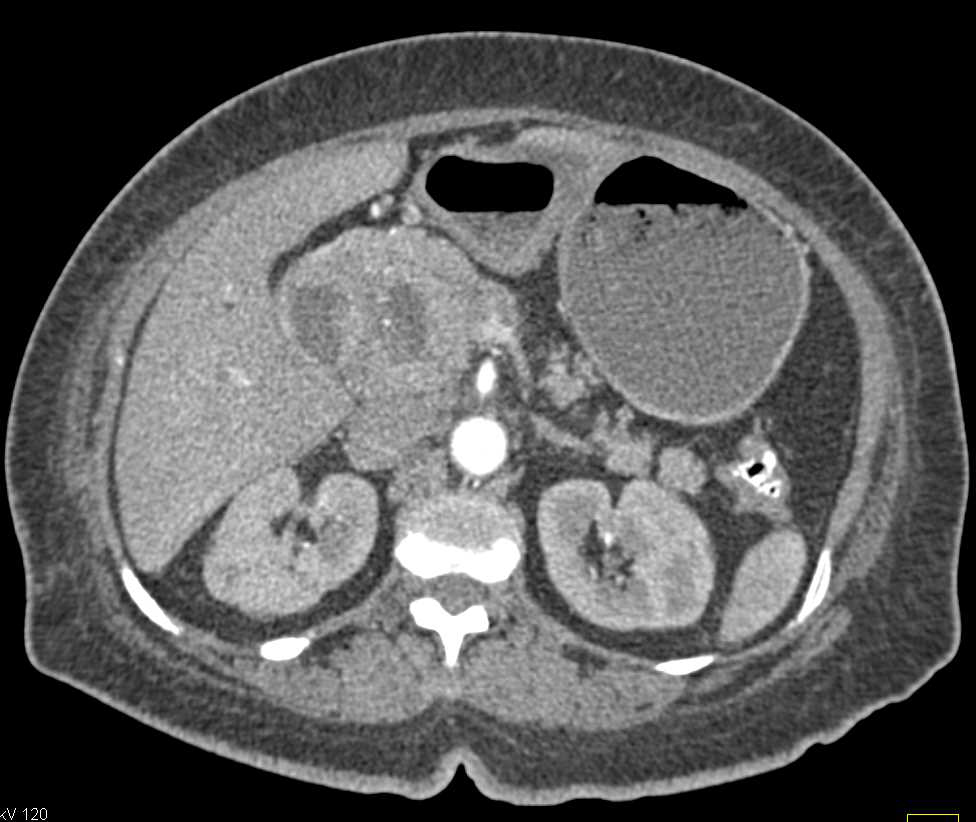 Ulcerating Duodenal GIST Tumor - CTisus CT Scan