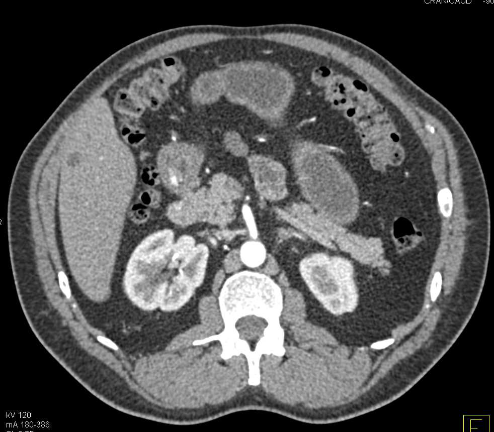 Duodenal Adenocarcinoma in D2 - CTisus CT Scan