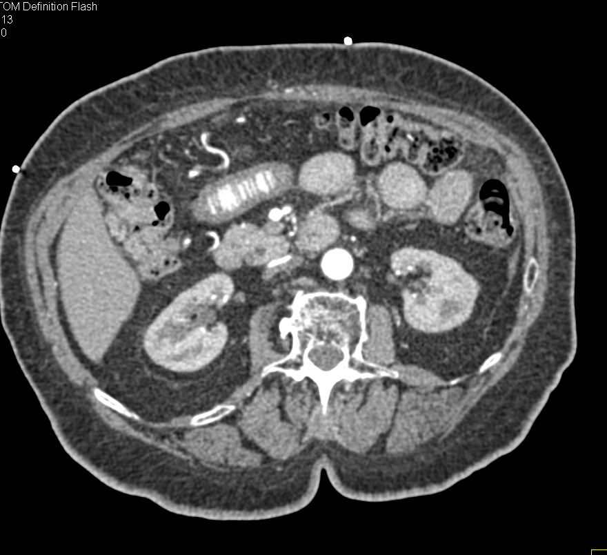 Extensive Bowel Wall Thickening due to Enterocolitis - CTisus CT Scan