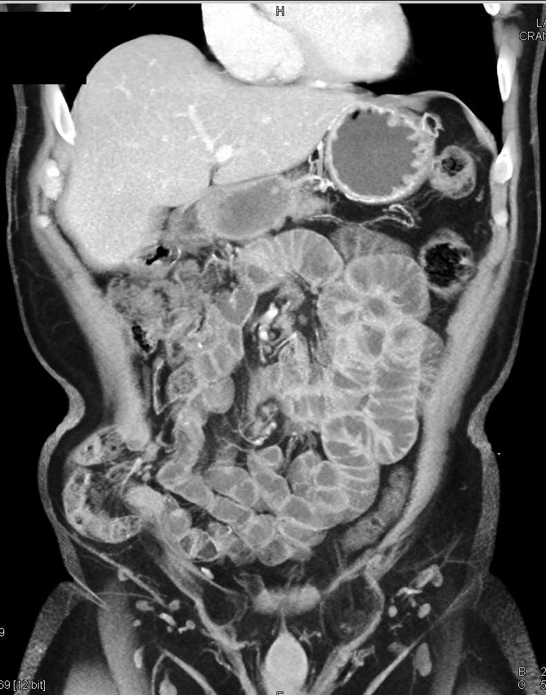 Small Bowel Hernia Through RLQ Defect in Abdominal Wall - CTisus CT Scan