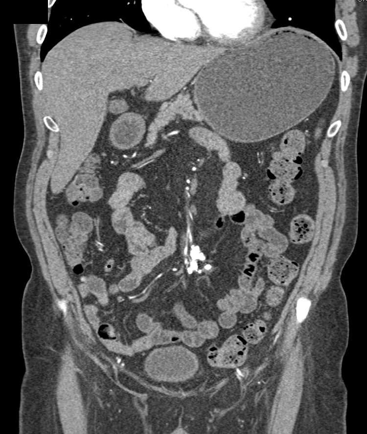 Mass in Mesentery is Sclerosing Mesenteritis with Dense Calcification - CTisus CT Scan