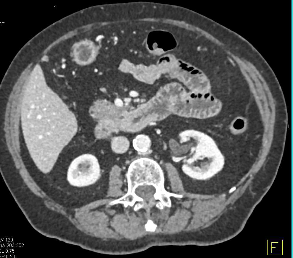 Adenocarcinoma of the Fourth Portion of the Duodenum - CTisus CT Scan