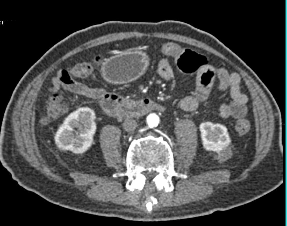 Duodenal Adenocarcinoma with Liver Metastases - CTisus CT Scan