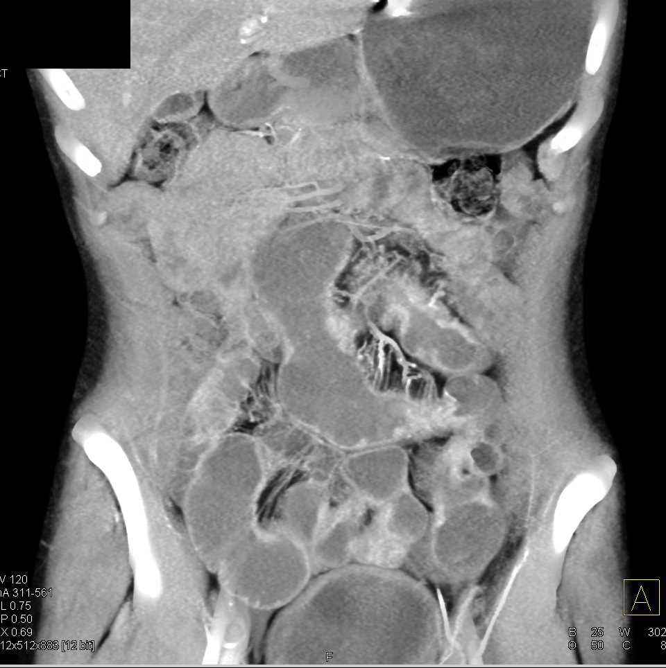 Thickening Small Bowel due to Infectious Enteritis - CTisus CT Scan