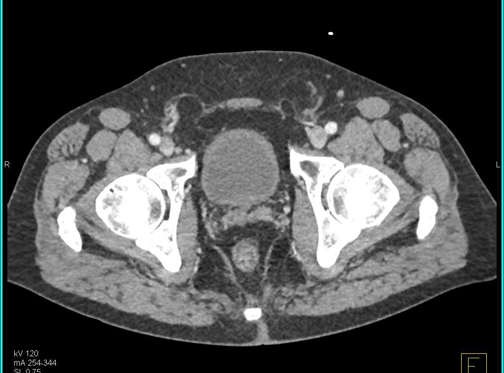 Crohn's Disease Colon and Terminal Ileum - CTisus CT Scan