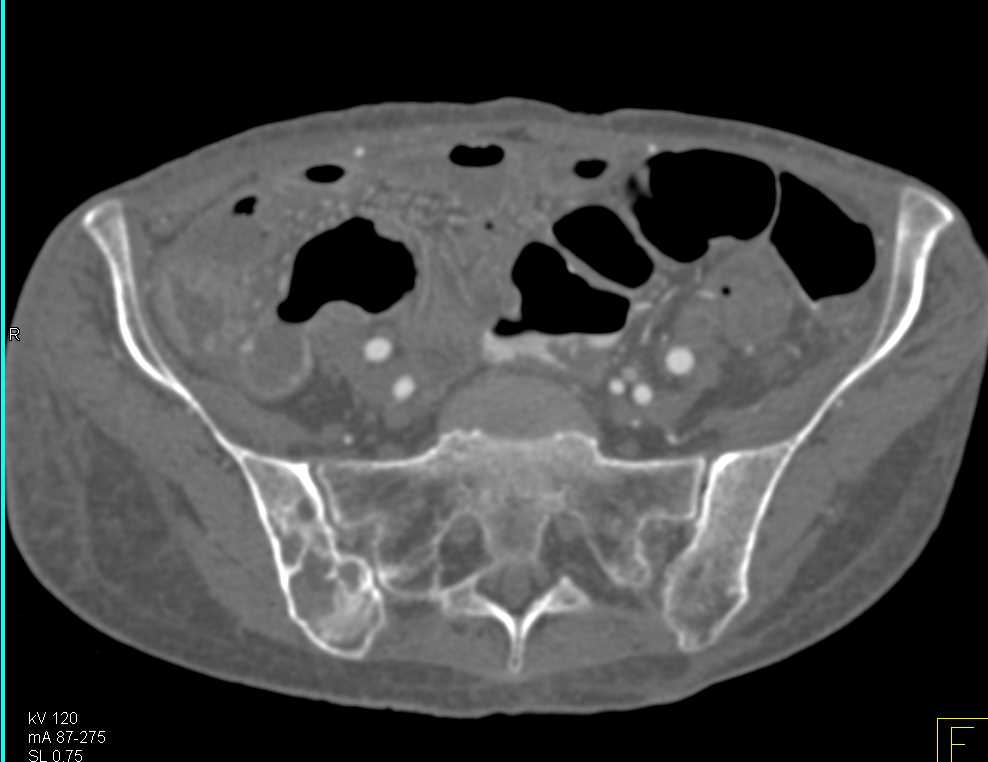 Enteritis Distal Small Bowel - CTisus CT Scan