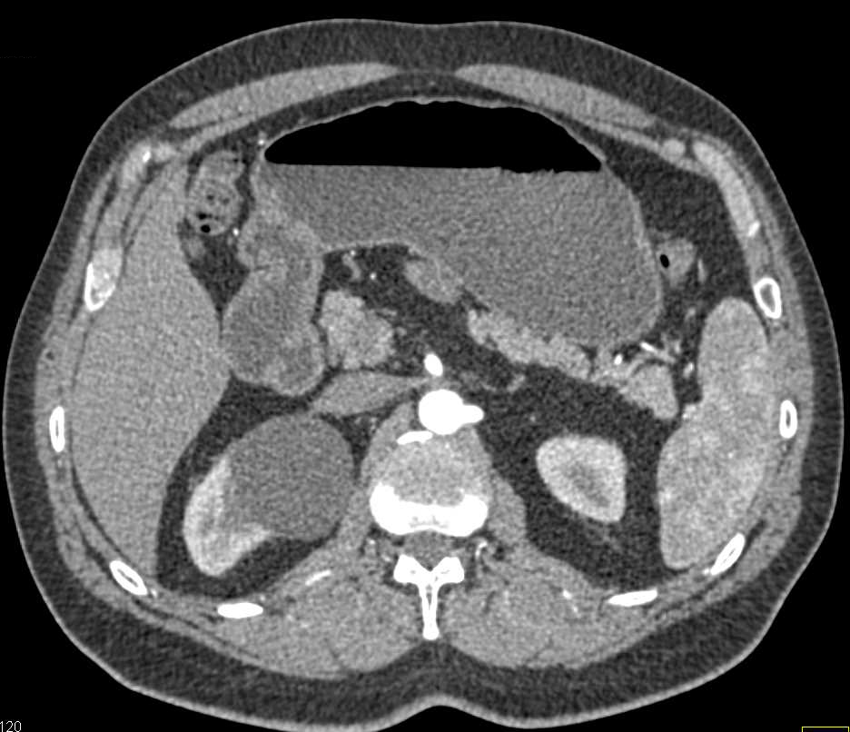 Carcinoid Tumor in the Root of the Mesentery with Calcification - CTisus CT Scan