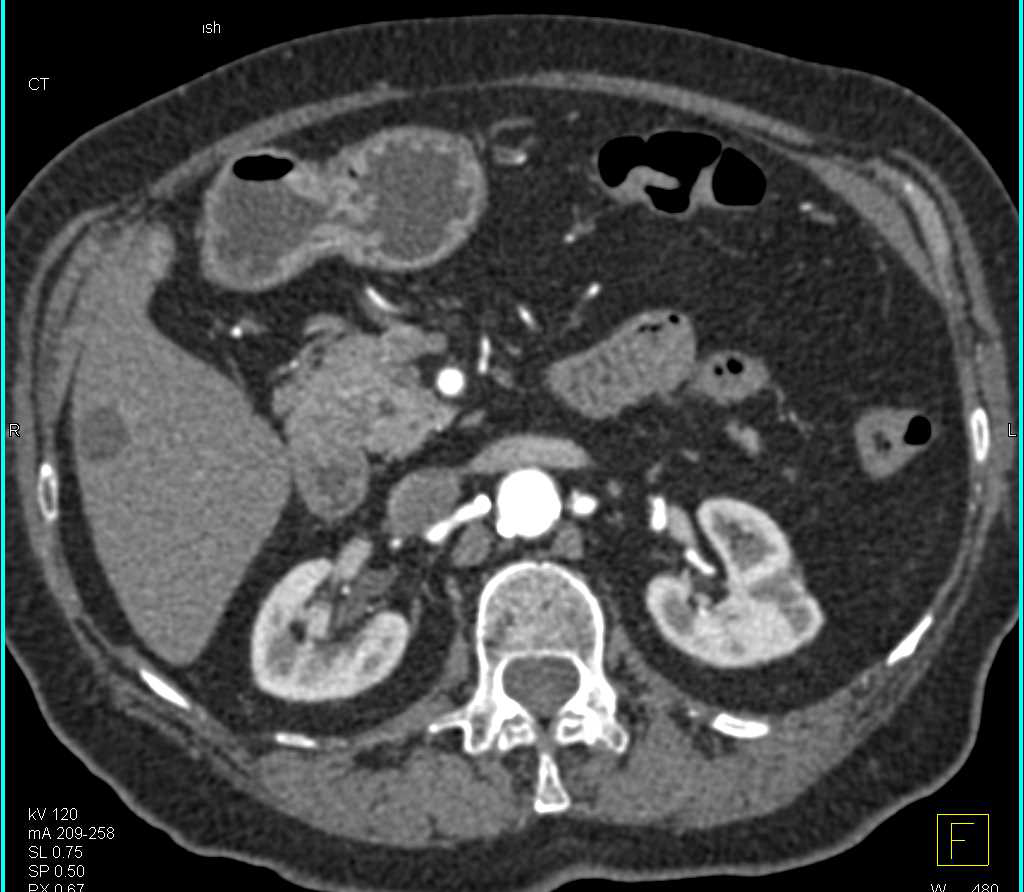 Adenocarcinoma of the Third Portion of the Duodenum - CTisus CT Scan