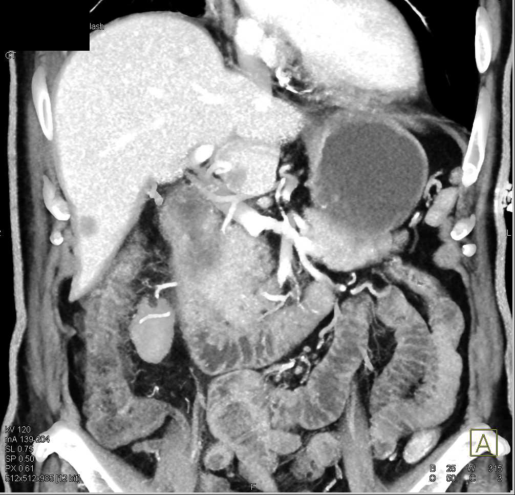 Duodenal Adenocarcinoma with Liver Metastases - CTisus CT Scan