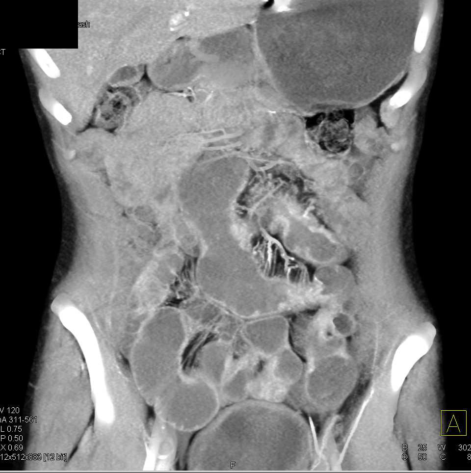 Distal Small Bowel Obstruction due to Lymphoma - CTisus CT Scan