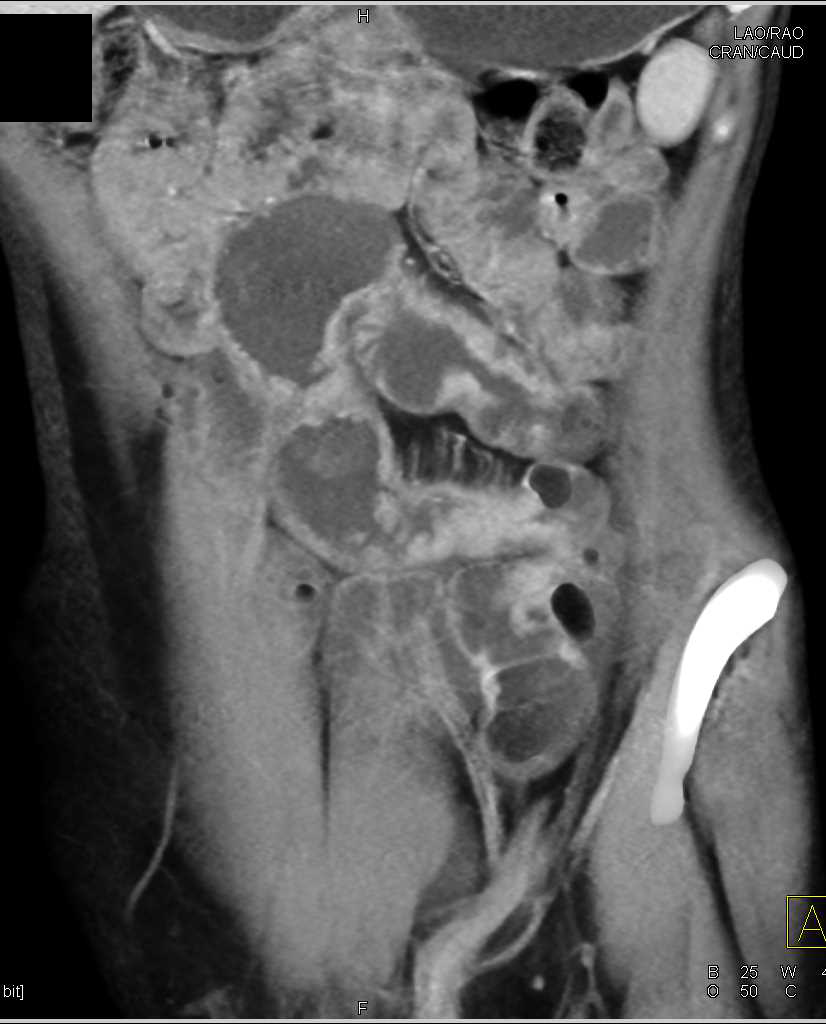 Distal Small Bowel Obstruction due to Lymphoma - CTisus CT Scan