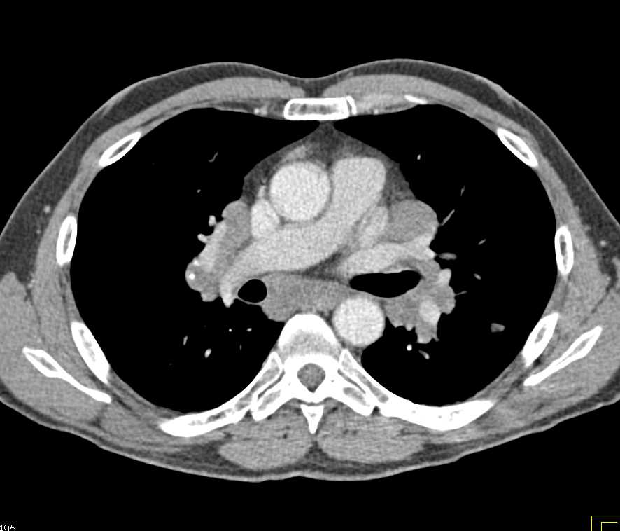 B-Cell Lymphoma with Adenopathy and Small Bowel Tumors - CTisus CT Scan