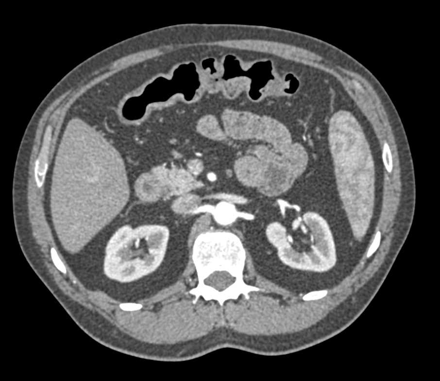 Crohn's Disease with Acute Flare-up and Colon and Small Bowel Involved - CTisus CT Scan