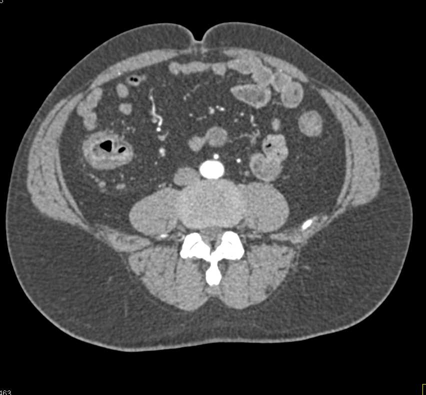 Crohn's Disease with Acute Flare-up and Colon and Small Bowel Involved - CTisus CT Scan