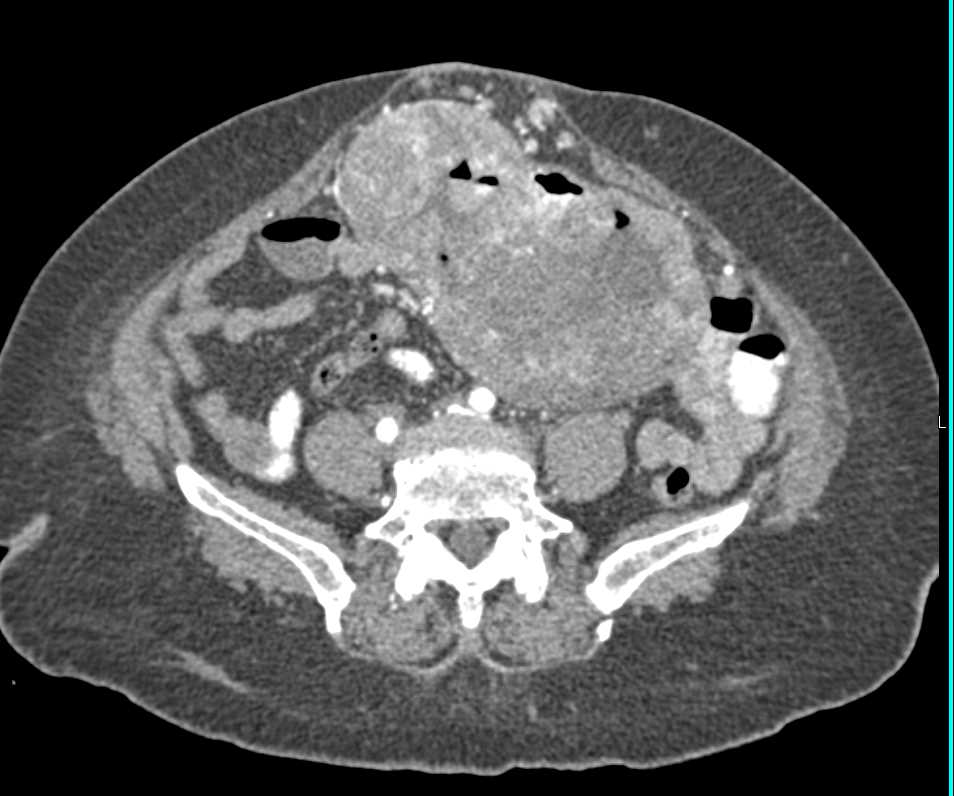 Ulcerating Small Bowel Lymphoma - CTisus CT Scan