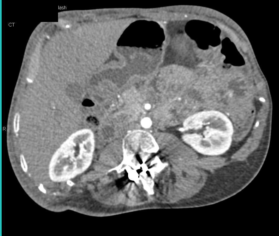 CT Study with Volumen and Good Bowel Opacification - CTisus CT Scan