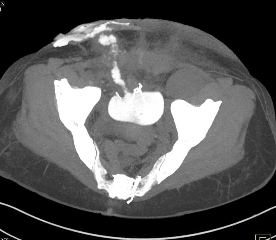 Thickening of Small Bowel at Osteomy Site - CTisus CT Scan