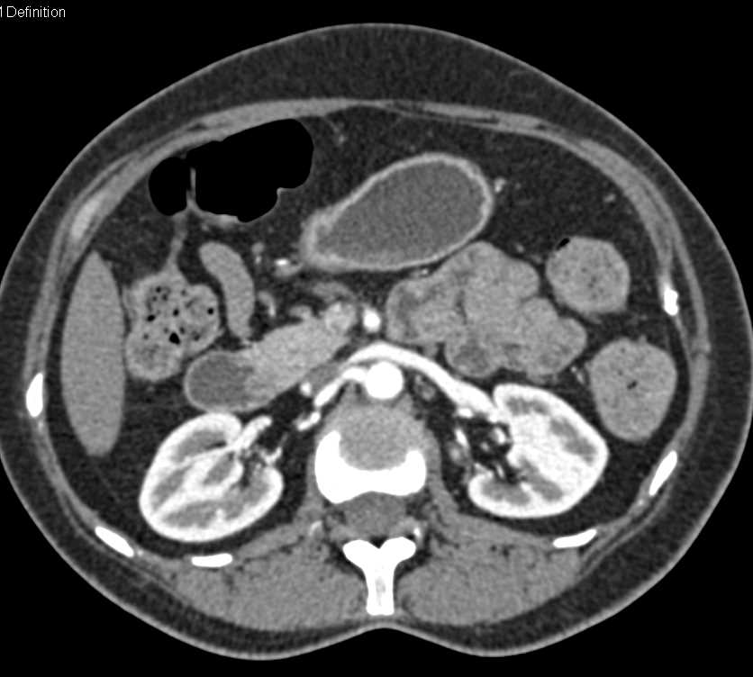 Duodenal Adenocarcinoma - CTisus CT Scan