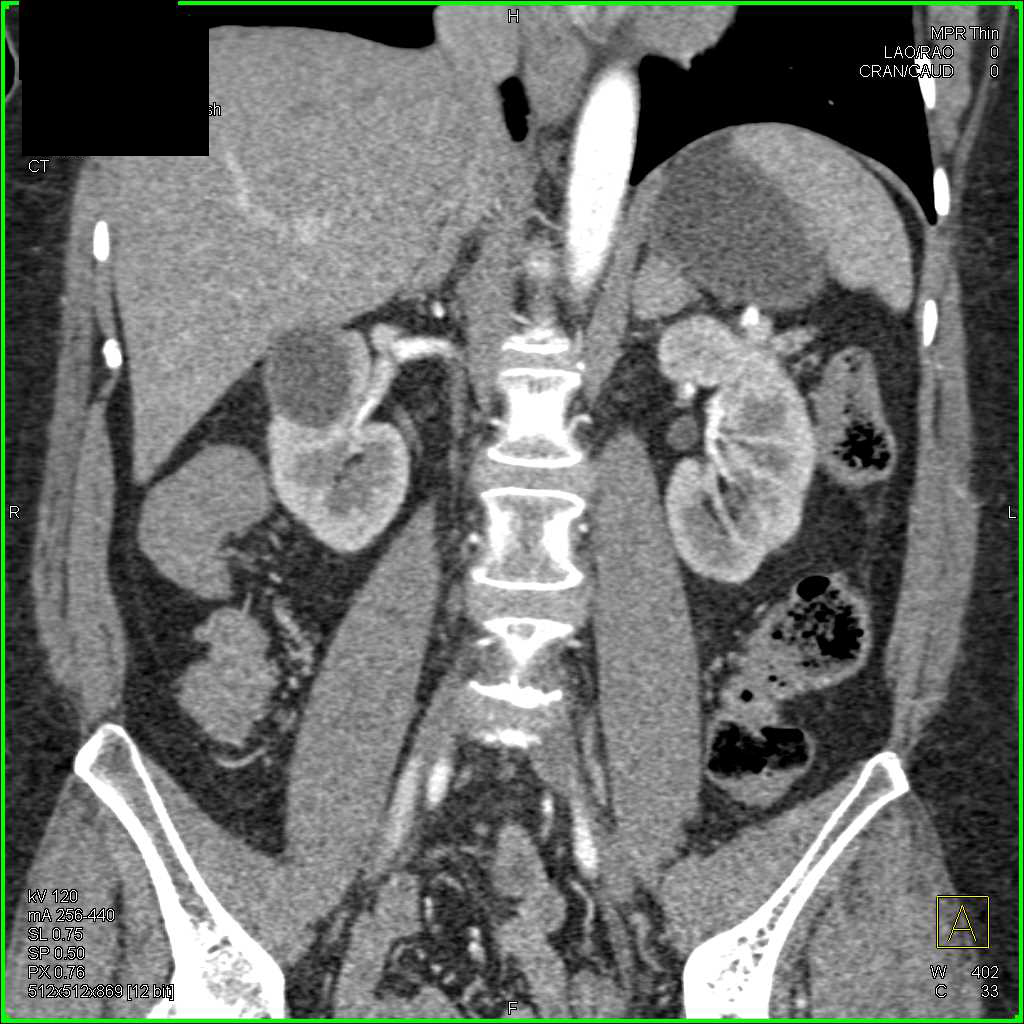 Duodenal Adenocarcinoma - CTisus CT Scan