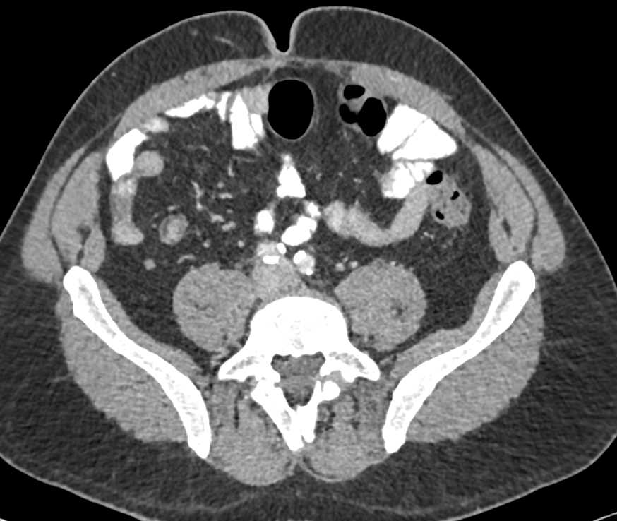 Crohn's Disease Small Bowel Ileum - CTisus CT Scan