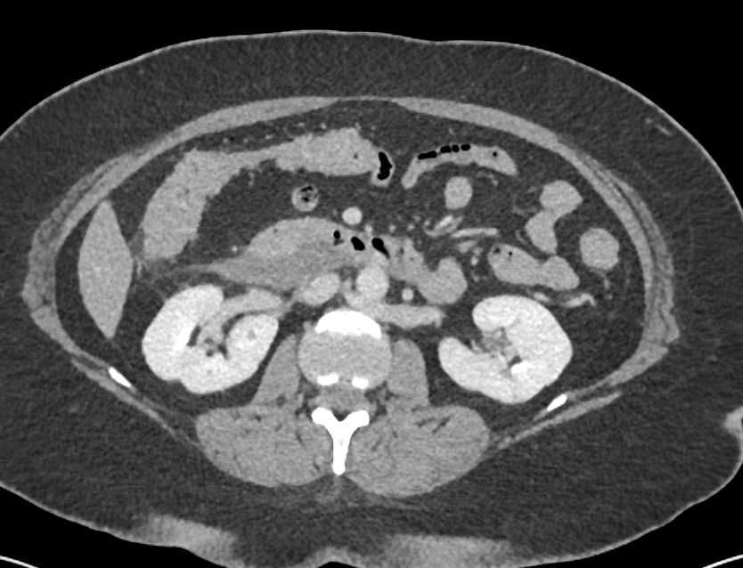 Active Bleed in the Duodenum - CTisus CT Scan