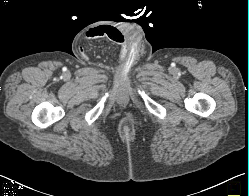 Small Bowel Hernia into the Scrotum - CTisus CT Scan