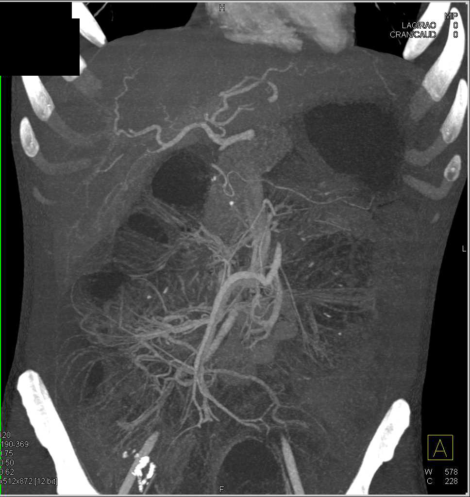 Small Bowel Obstruction (SBO) due to Stricture due to Crohn's Disease - CTisus CT Scan