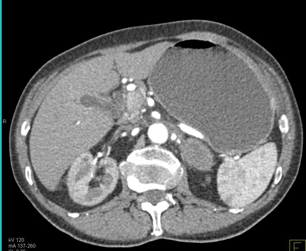 Duodenal Adenocarcinoma in the 3rd Portion of the Duodenum - CTisus CT Scan