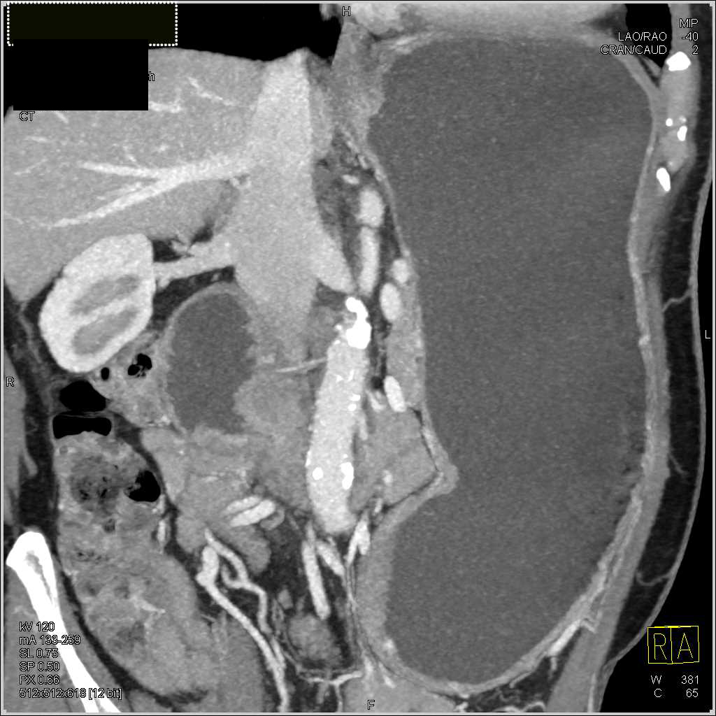 Duodenal Adenocarcinoma in the 3rd Portion of the Duodenum - CTisus CT Scan