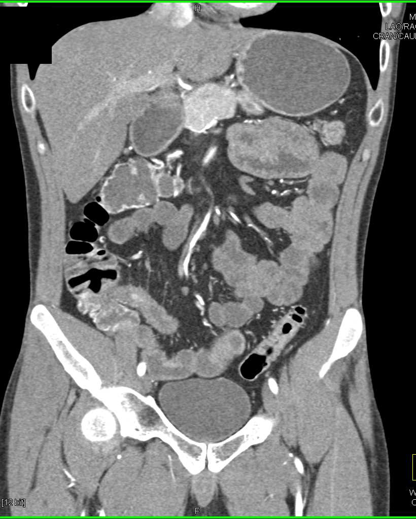 Crohn's Disease Involving Ileum - CTisus CT Scan