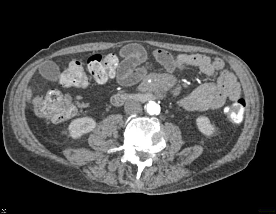 Carcinoid Tumor in Root of Mesentery - CTisus CT Scan