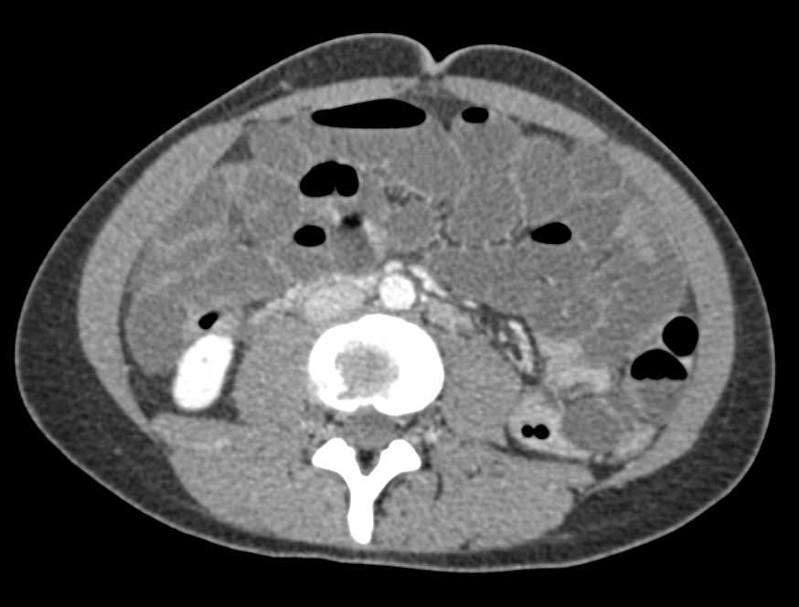 Small Bowel Obstruction due to Adhesions - CTisus CT Scan