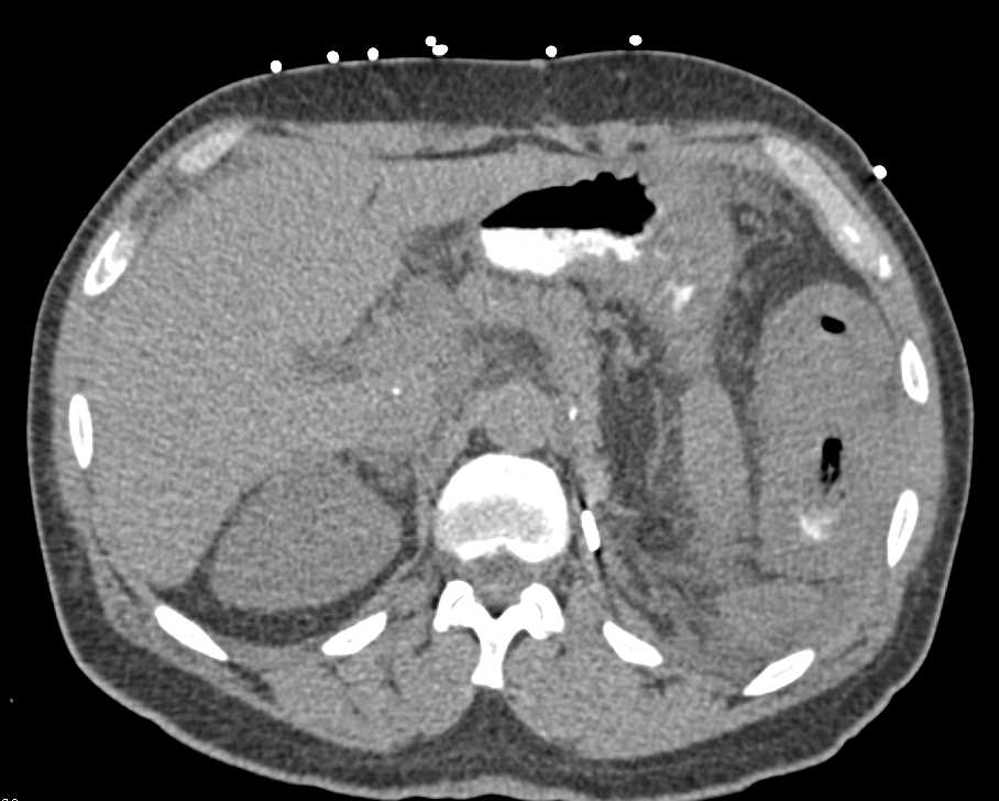 Small Bowel Lymphoma - CTisus CT Scan