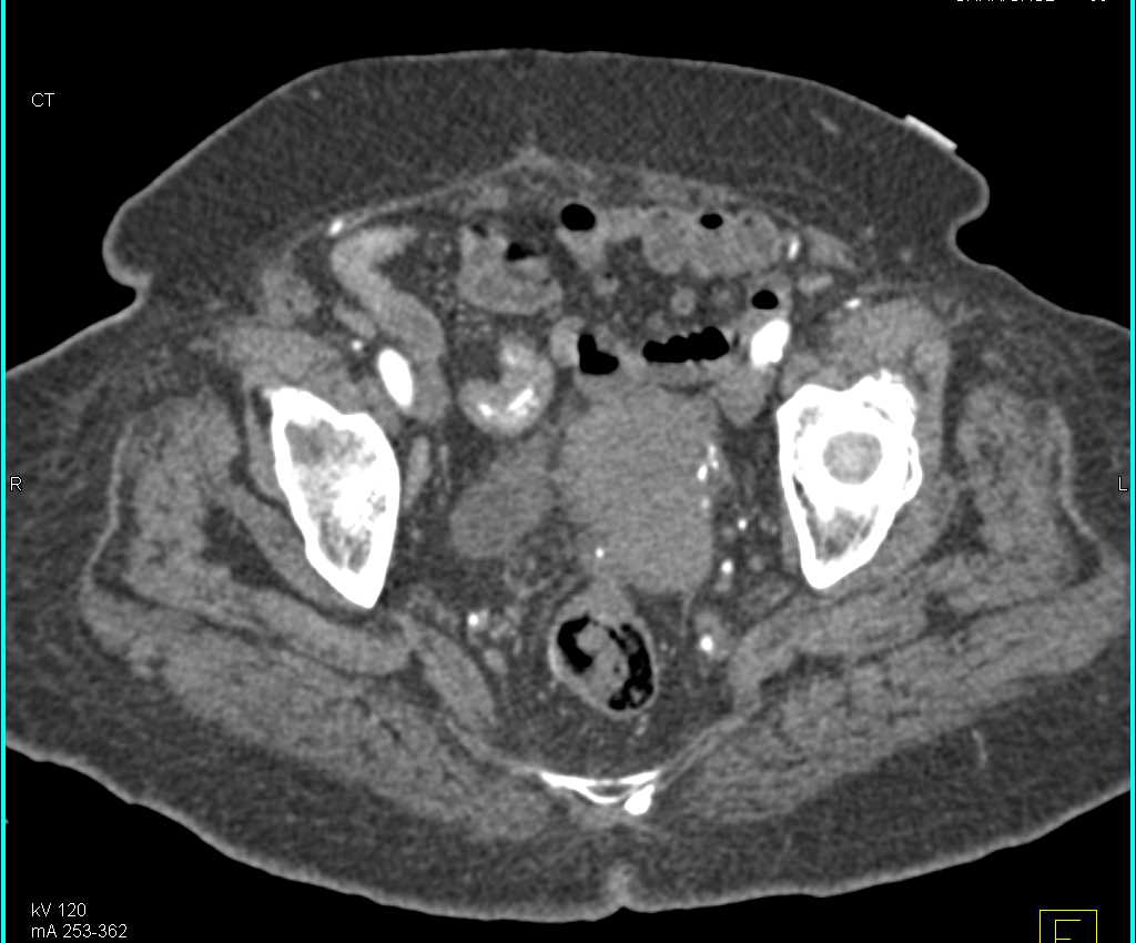 Gastrointestinal (GI) Bleed in the Terminal Ileum - CTisus CT Scan